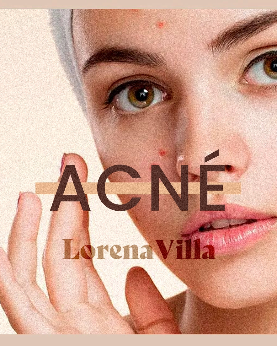 Comprender el acné Dra Lorena Villa dermatología Ecuador