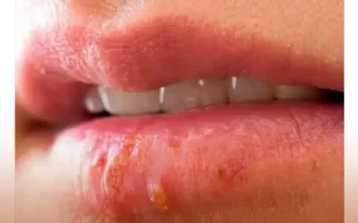 Herpes Simple Tipo 1: Causas, Síntomas y Tratamiento