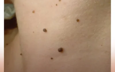 Prevención y Detección Temprana del Cáncer de Piel