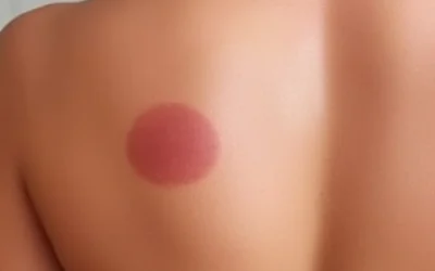 Tratamiento de Manchas en Cuenca: Soluciones para tu Piel