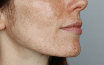 Piel Saludable en Ecuador: Guía Completa de Dermatología