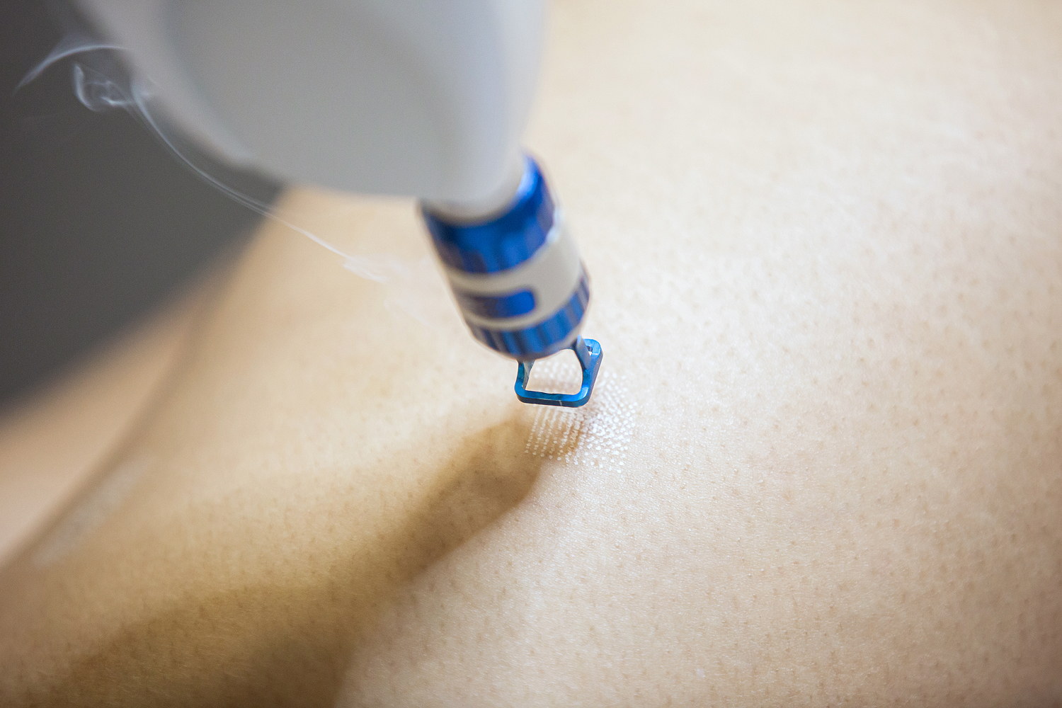 laser-hair-removal-procedure-close-up-detail-2026-03-18-16-04-23-utc