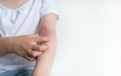 Guía completa sobre el manejo de dermatitis atópica en Ecuador