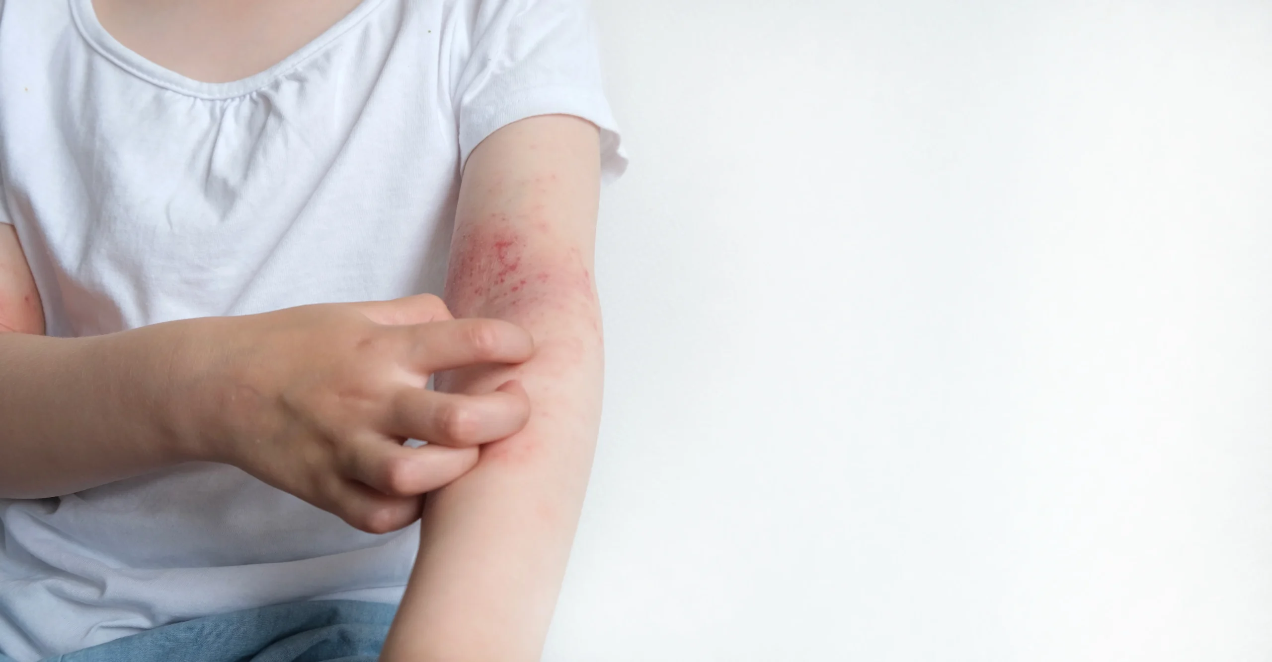 child-scratches-itchy-arm-in-studio-setting-2026-09-23-01-34-25-utc Guía completa sobre el manejo de dermatitis atópica en Ecuador