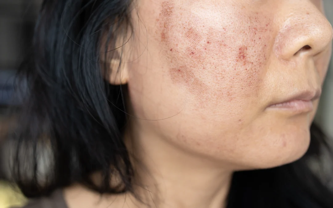 Guía completa para tratar el melasma y manchas en Ecuador