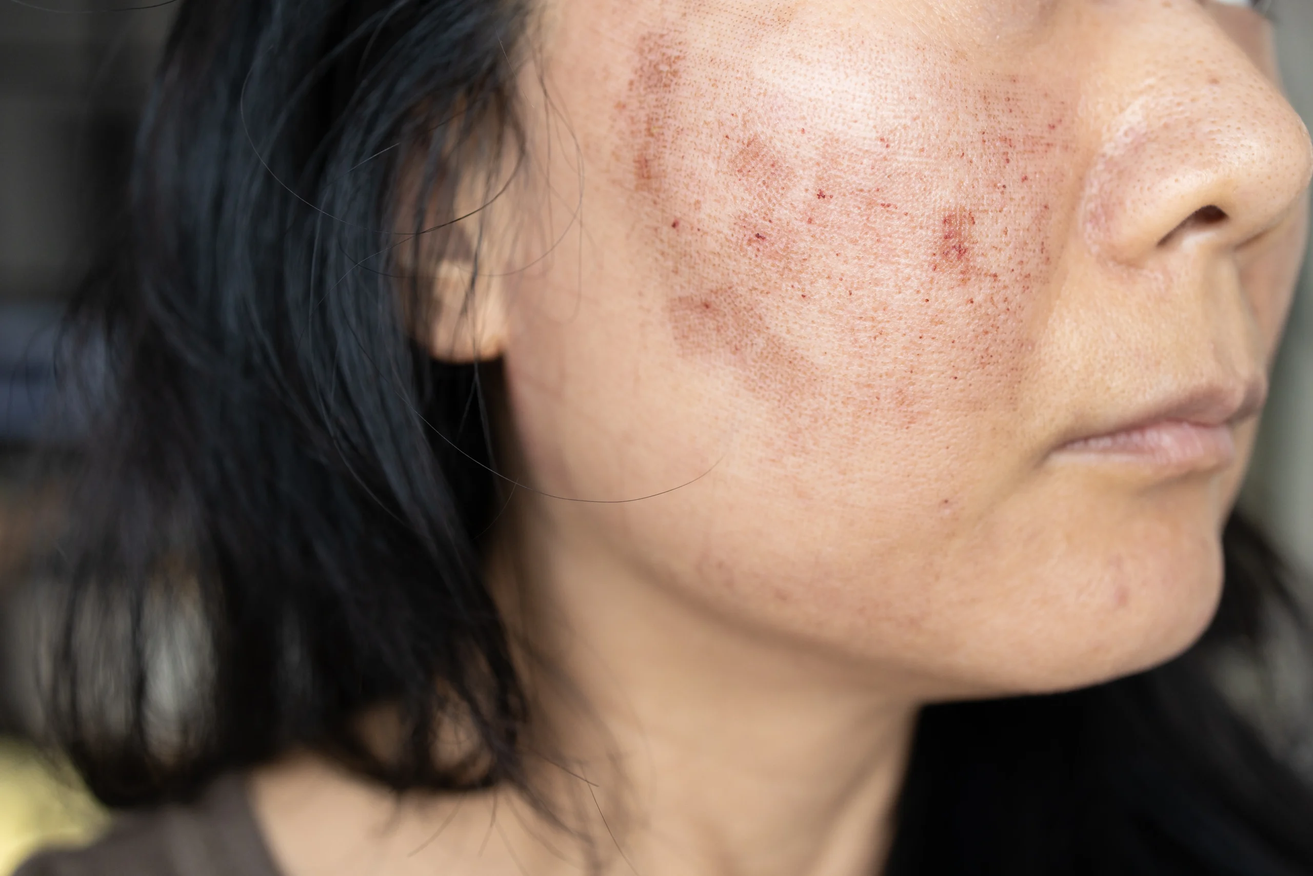 close-up-of-woman-s-face-showing-post-treatment-ma-2026-03-24-10-14-24-utc