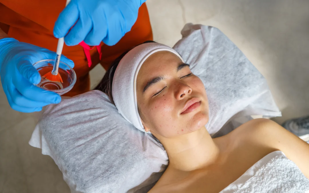 Peeling químico facial en Ecuador: renueva tu piel dermatológicamente