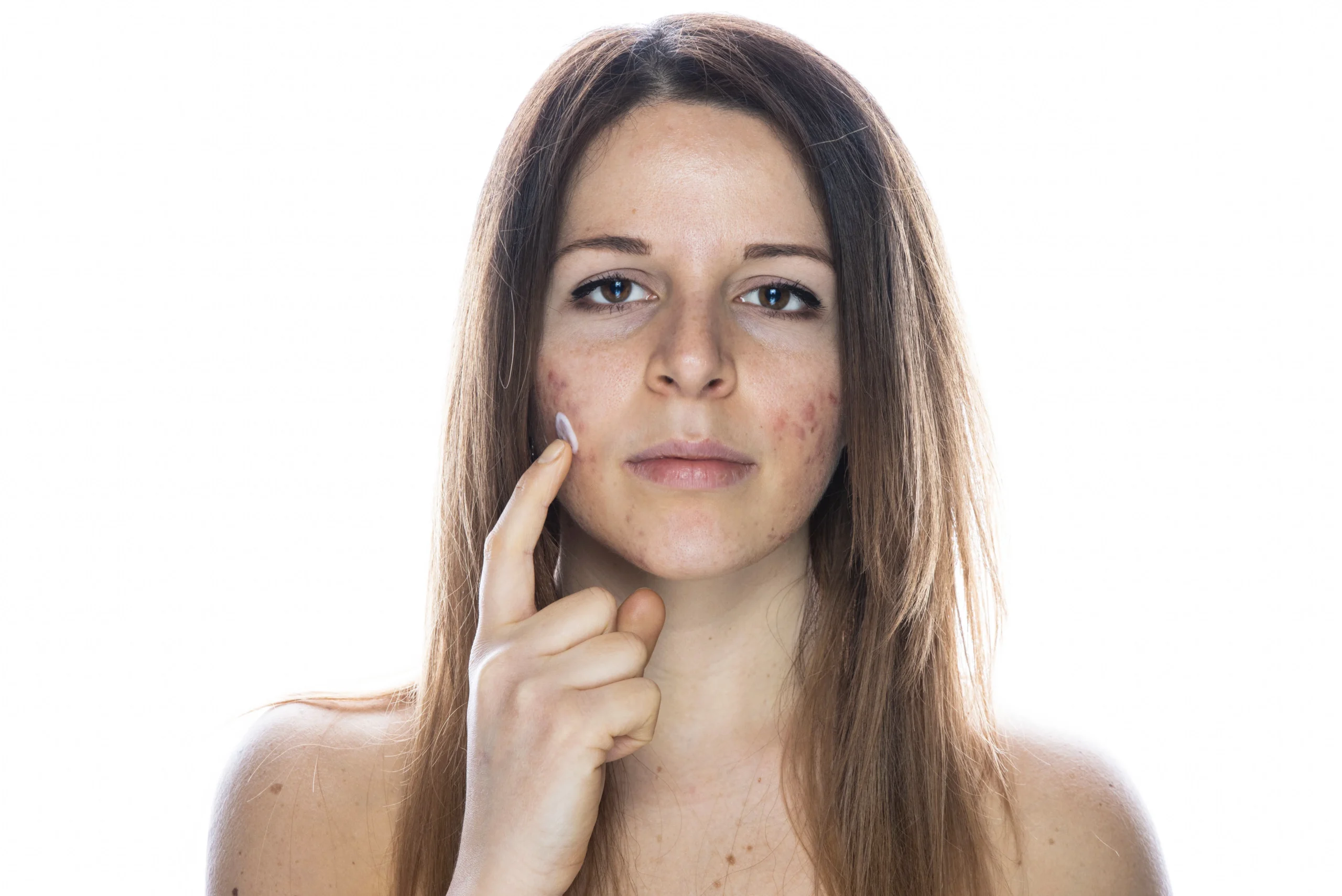young-woman-applying-cream-to-her-face-2026-09-23-12-42-04-utc Guía completa sobre el melasma y sus tratamientos