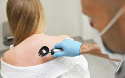 Prevención y diagnóstico del melanoma en Cuenca, Ecuador